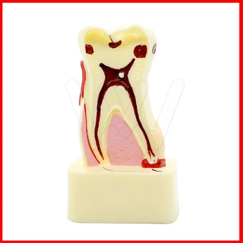 модел на зъба дентална патология модел зъби, кариес на зъбите, зъбен камък, камъни в целулоза, окклюзионный износване на зъбите